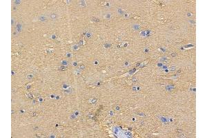 ABIN6261423 and ABIN6272638 at 1/100 staining human glioblastoma by IHC-P.
