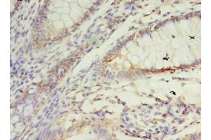Immunohistochemistry of paraffin-embedded human colon cancer using ABIN7172922 at dilution of 1:100 (SSR3 抗体  (AA 77-135))