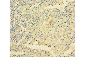 Immunohistochemistry of paraffin-embedded human lung cancer using ABIN7175481 at dilution of 1:100 (VAMP5 抗体  (AA 1-72))