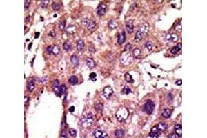 IHC analysis of FFPE human hepatocarcinoma stained with the AMFR antibod (AMFR 抗体  (AA 571-601))