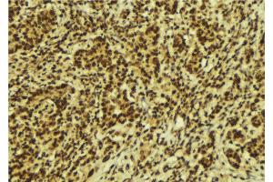 ABIN6274165 at 1/100 staining Human breast cancer tissue by IHC-P.