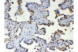 IHC testing of FFPE human lung cancer tissue with ETV6 antibody at 1ug/ml. (ETV6 抗体)