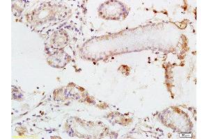 Formalin-fixed and paraffin embedded human colon carcinoma tissue labeled with Rabbit Anti-TEM1/CD248 Polyclonal Antibody  at 1:200 followed by conjugation to the secondary antibody and DAB staining.