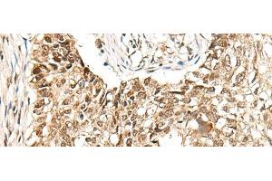 Immunohistochemistry of paraffin-embedded Human lung cancer tissue using CCDC181 Polyclonal Antibody at dilution of 1:50(x200) (C1orf114 抗体)