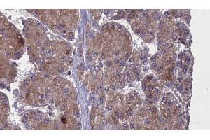 ABIN6272762 at 1/100 staining Human liver cancer tissue by IHC-P. (OR52N2 抗体  (C-Term))