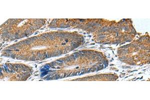 Immunohistochemistry of paraffin-embedded Human colorectal cancer tissue using HSD11B1 Polyclonal Antibody at dilution of 1:70(x200) (HSD11B1 抗体)