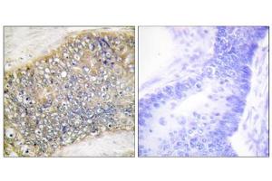 Immunohistochemistry analysis of paraffin-embedded human colon carcinoma tissue using TALL-2 antibody. (TNFSF13 抗体  (Internal Region))