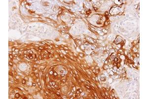IHC-P Image Immunohistochemical analysis of paraffin-embedded SCC4 xenograft, using GBP1, antibody at 1:100 dilution. (GBP1 抗体  (Internal Region))