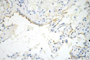 Immunohistochemistry was performed on paraffin-embedded human lung adenocarcinoma using phospho-EGFR (Y) antibody (ABIN7798468), 1:200). (Recombinant EGFR 抗体  (pTyr1068))