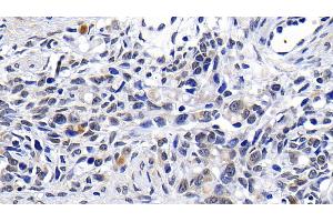 Detection of ATM in Human Ovarian cancer Tissue using Polyclonal Antibody to Ataxia Telangiectasia Mutated (ATM) (ATM 抗体  (AA 2484-2748))