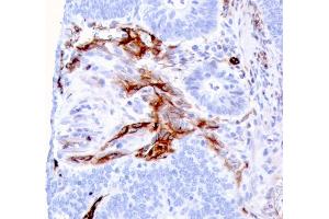 Formalin-fixed, paraffin-embedded human Colon Carcinoma stained with Nestin Mouse Monoclonal Antibody (NES/2911). (Nestin 抗体  (AA 698-844))