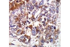 IHC analysis of FFPE human hepatocarcinoma stained with the cGKI beta antibody (PRKG1 抗体  (AA 629-660))
