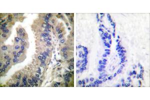 Peptide - +Immunohistochemical analysis of paraffin-embedded human lung carcinoma tissue using HSP90 cyto antibody (#C0234). (HSP90AA1 抗体)