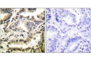 Immunohistochemistry analysis of paraffin-embedded human lung carcinoma tissue, using NF-kappaB p65 (Acetyl-Lys310) Antibody. (NF-kB p65 抗体  (acLys310))