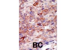 Formalin-fixed and paraffin-embedded human cancer tissue reacted with the primary antibody, which was peroxidase-conjugated to the secondary antibody, followed by DAB staining. (YWHAB 抗体  (N-Term))