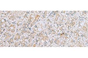 Immunohistochemistry of paraffin-embedded Human liver cancer tissue using LRRC49 Polyclonal Antibody at dilution of 1:40(x200) (LRRC49 抗体)