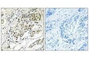 Immunohistochemistry analysis of paraffin-embedded human breast carcinoma tissue using CDYL2 antibody. (CDYL2 抗体  (N-Term))