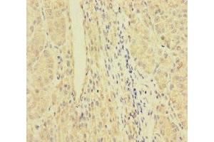 Immunohistochemistry of paraffin-embedded human liver cancer using ABIN7167064 at dilution of 1:100 (RFTN2 抗体  (AA 1-300))