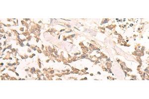Immunohistochemistry of paraffin-embedded Human lung cancer tissue using EN2 Polyclonal Antibody at dilution of 1:30(x200) (EN2 抗体)