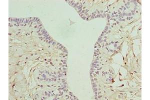 Immunohistochemistry of paraffin-embedded human breast cancer using ABIN7166405 at dilution of 1:100 (ARMT1 (AA 2-250) 抗体)
