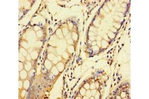 Immunohistochemistry of paraffin-embedded human colon cancer using ABIN7148417 at dilution of 1:100 (NDUFAF1 抗体  (AA 25-327))