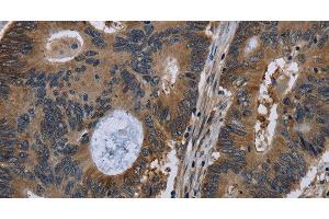 Immunohistochemistry of paraffin-embedded Human colon cancer tissue using TSC22D3 Polyclonal Antibody at dilution 1:40 (TSC22D3 抗体)