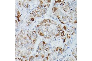 Immunohistochemistry of paraffin-embedded human liver cancer using Alkaline Phosphatase (ALPL) Rabbit pAb (ABIN3021385, ABIN3021386, ABIN1512569 and ABIN6214987) at dilution of 1:50 (40x lens). (ALPL 抗体  (AA 20-270))