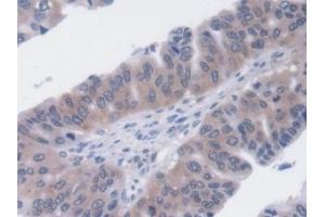 Detection of UCP2 in Human Liver cancer Tissue using Monoclonal Antibody to Mitochondrial Uncoupling Protein 2 (UCP2) (UCP2 抗体  (AA 154-289))