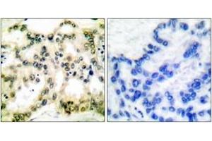 Immunohistochemistry analysis of paraffin-embedded human lung carcinoma, using Cyclin B1 (Phospho-Ser126) Antibody. (Cyclin B1 抗体  (pSer126))