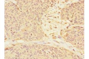Immunohistochemistry of paraffin-embedded human ovarian cancer using ABIN7167139 at dilution of 1:100 (RASSF6 抗体  (AA 1-303))