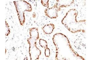 Formalin-fixed, paraffin-embedded human breast carcinoma stained with anti-Calponin antibody (CNN1/832). (Calponin 抗体)