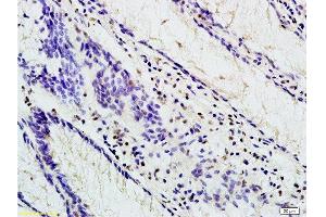 Formalin-fixed and paraffin embedded human colon carcinoma labeled with Anti-TBL1X Polyclonal Antibody, Unconjugated at 1:200 followed by conjugation to the secondary antibody and DAB staining (TBL1Y 抗体  (AA 501-577))