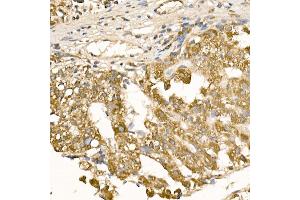 Immunohistochemistry of paraffin-embedded human liver cancer using [KO Validated] RA Rabbit pAb (ABIN3021646, ABIN3021647, ABIN3021648 and ABIN1513457) at dilution of 1:100 (40x lens). (RAB5 抗体  (AA 1-215))