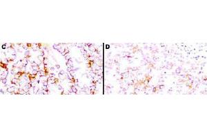 Immunohistochemistry (IHC) image for anti-Mesothelin (MSLN) (Extracellular Domain) antibody (ABIN400817) (Mesothelin 抗体  (Extracellular Domain))