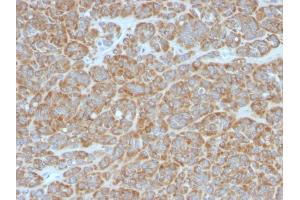 Formalin-fixed, paraffin-embedded human Melanoma stained with Bcl-2 Mouse Monoclonal Antibody (BCL2/796). (Bcl-2 抗体)
