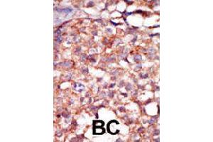 Formalin-fixed and paraffin-embedded human cancer tissue reacted with RIPK4 polyclonal antibody  , which was peroxidase-conjugated to the secondary antibody, followed by AEC staining. (RIPK4 抗体  (C-Term))