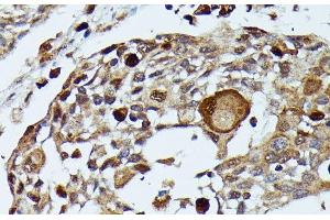 Immunohistochemistry of paraffin-embedded Human esophageal cancer using MAP3K3 Polyclonal Antibody at dilution of 1:100 (40x lens). (MAP3K3 抗体)