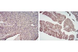 Immunohistochemical analysis of paraffin-embedded cervical cancer tissues (left) and ovarian cancer tissues (right) using CD276 mouse mAb with DAB staining. (CD276 抗体)