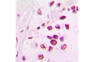 Immunohistochemical analysis of TEL staining in human lung cancer formalin fixed paraffin embedded tissue section. (ETV6 抗体  (C-Term))