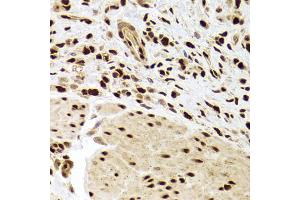Immunohistochemistry of paraffin-embedded human gastric cancer using ANP32A Antibody (ABIN5973390) at dilution of 1/100 (40x lens). (PHAP1 抗体)