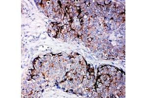 IHC-P: TIMP2 antibody testing of human breast cancer tissue