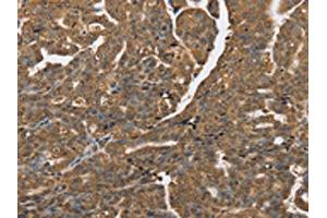 The image on the left is immunohistochemistry of paraffin-embedded Human cervical cancer tissue using ABIN7192064(PTPN20A/PTPN20B Antibody) at dilution 1/40, on the right is treated with synthetic peptide. (PTPN2 抗体)