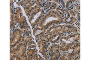 Immunohistochemistry of Human thyroid cancer using NAT10 Polyclonal Antibody at dilution of 1:40 (NAT10 抗体)