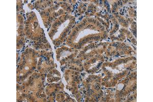 Immunohistochemistry of Human thyroid cancer using NAT10 Polyclonal Antibody at dilution of 1:40