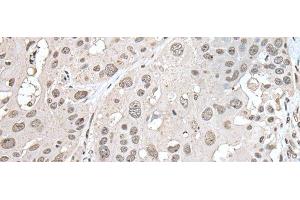 Immunohistochemistry of paraffin-embedded Human esophagus cancer tissue using VRK1 Polyclonal Antibody at dilution of 1:30(x200) (VRK1 抗体)