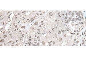Immunohistochemistry of paraffin-embedded Human esophagus cancer tissue using VRK1 Polyclonal Antibody at dilution of 1:30(x200)