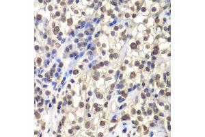 Immunohistochemistry of paraffin-embedded human kidney cancer using CENPC antibody at dilution of 1:200 (400x lens). (CENPC1 抗体)