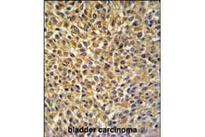 CRIP1 Antibody IHC analysis in formalin fixed and paraffin embedded bladder carcinoma followed by peroxidase conjugation of the secondary antibody and DAB staining. (CRIP1 抗体  (C-Term))