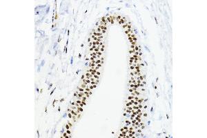 Immunohistochemistry of paraffin-embedded human mammary cancer using ZEB1 antibody (ABIN6129933, ABIN6150422, ABIN6150423 and ABIN6221237) at dilution of 1:200 (40x lens).