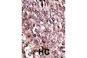 Formalin-fixed and paraffin-embedded human hepatocellular carcinoma tissue reacted with MAGEC1 polyclonal antibody  , which was peroxidase-conjugated to the secondary antibody, followed by AEC staining. (MAGEC1 抗体  (C-Term))